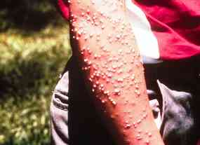 Photos+of+Cow+Ant+Bites Pustules from RIFA stings. Photo: Murray S. Blum, The University of ...